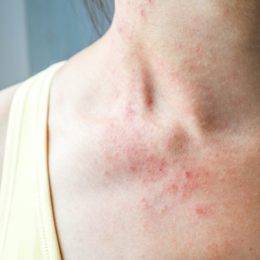 Managing and Soothing Heat Rash: Your Summer Survival Guide